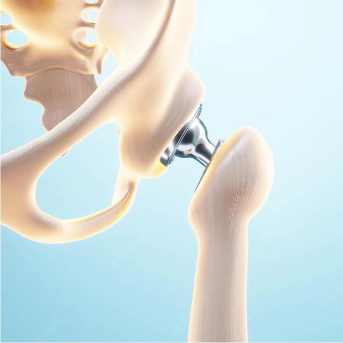 Hip Prosthesis