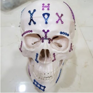 Maxillofacial Implants