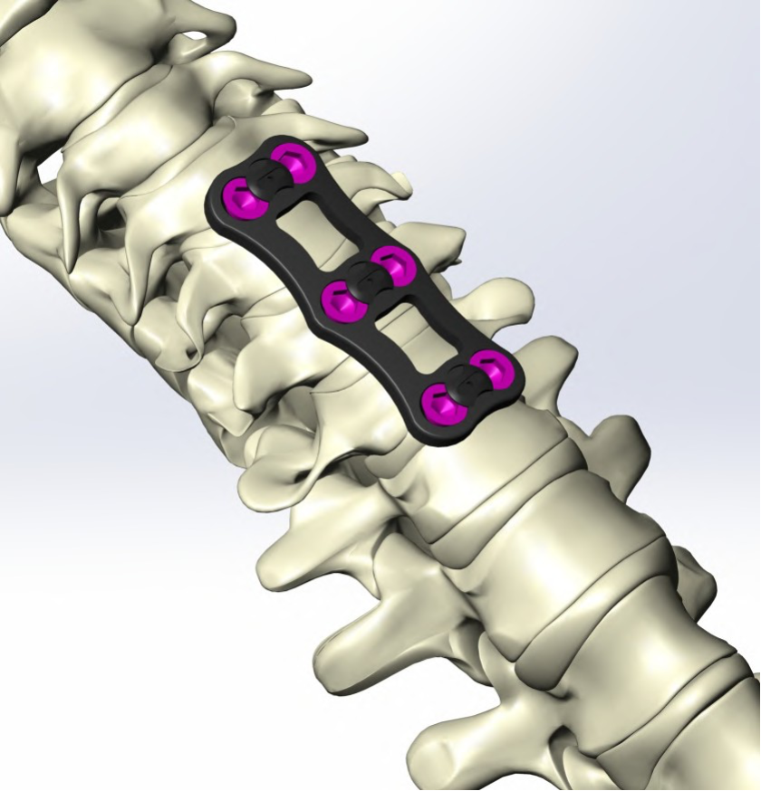 Spine Implants
